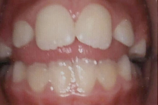 Caso 2 Mordida abierta 2017